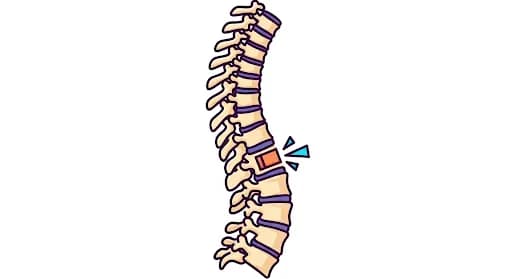Bukan Cuma Otak, Stroke Ternyata Juga Bisa Serang Sumsum Tulang Belakang!